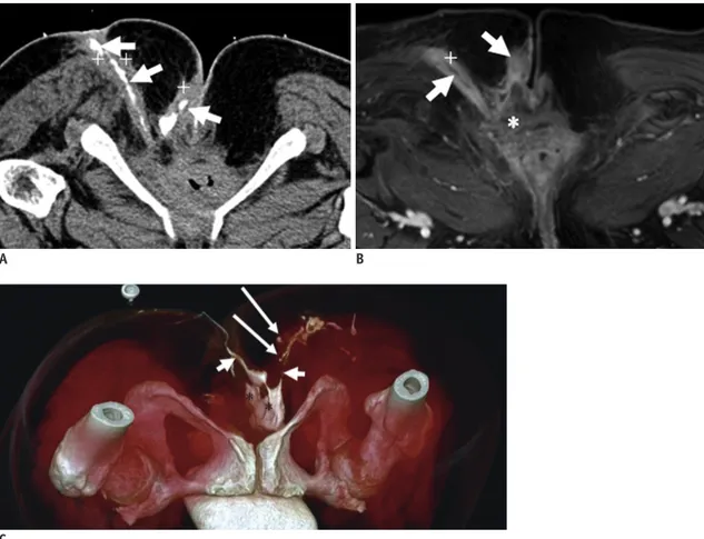 Fig. 4. 44-year-old female with recurrent fistulas after two operations.