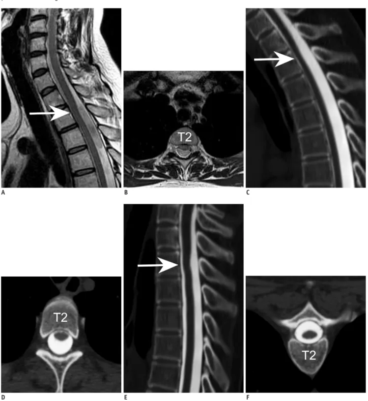 Fig. 2. Cervical spine magnetic resonance imaging (A-D) and additional computed tomography (CT) myelography (E, F) of  38-year-old woman who presented with neck pain