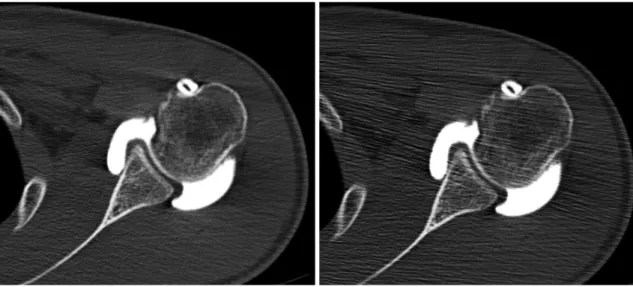 Fig. 1. Axial CT arthrographic images obtained by thin-slab-averaging reformation and conventional reconstruction in 24-year-old  man for postoperative evaluation of SLAP lesion.