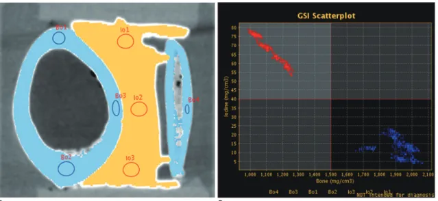 Fig. 3. Bone-iodine differentiation in virtual monochromatic spectral (VMS) imaging mode.
