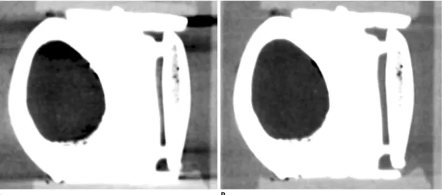 Fig. 5. Comparison of beam-hardening artifacts between  72 keV virtual monochromatic spectral (VMS) images and  conventional CT images.