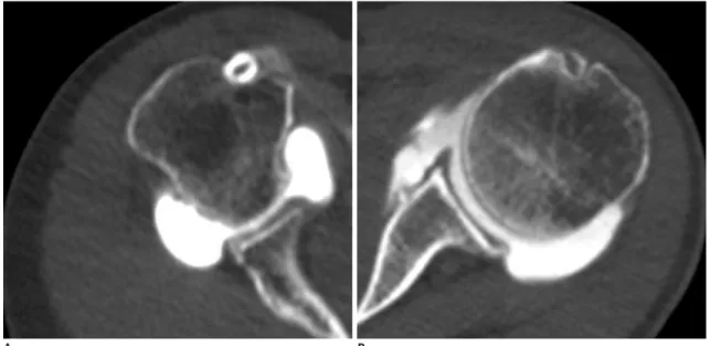 Fig. 7. Clinical evaluation of shoulder dual-energy CT arthrography with virtual monochromatic spectral (VMS) imaging: 