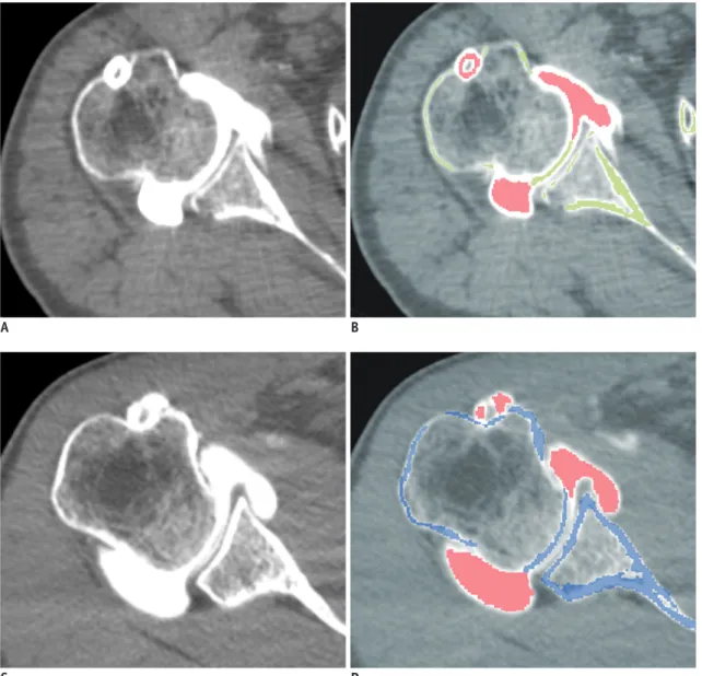 Fig. 8. Clinical evaluation of shoulder dual-energy CT (DECT) arthrography with virtual monochromatic spectral (VMS) imaging: 