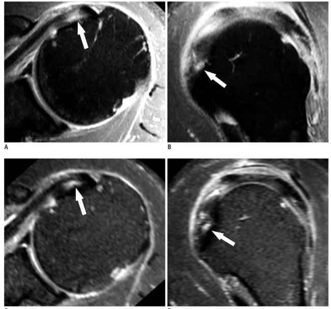 Fig. 4. Arthroscopically proven tear of subscapularis (SSC) tendon of left shoulder in 59-year-old man