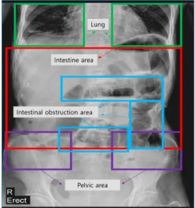 Fig.  1  X-ray  Image  of  Intestinal  Obstruction