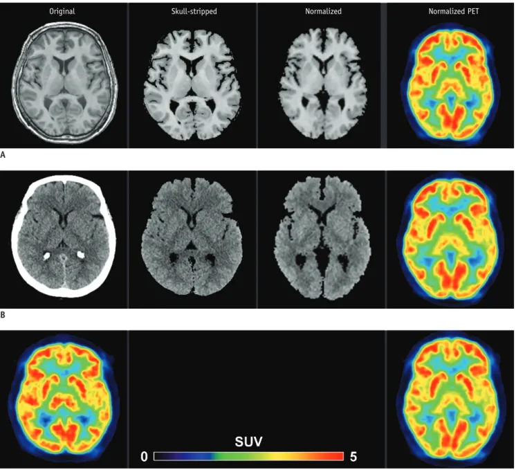 Fig. 3. 57-year-old female subject showing results of MR- (A), CT- (B), and PET-based spatial normalization (C).