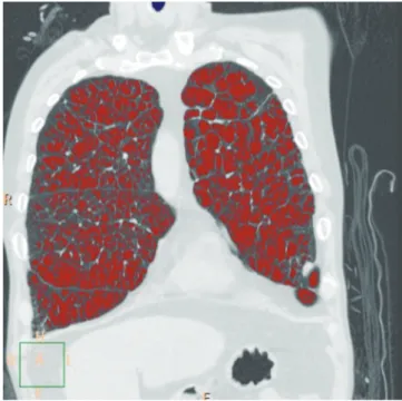 Fig. 2. Coronal reformatted lung window image in 57-year- 57-year-old man with severe chronic obstructive pulmonary disease  amenable to lung transplantation