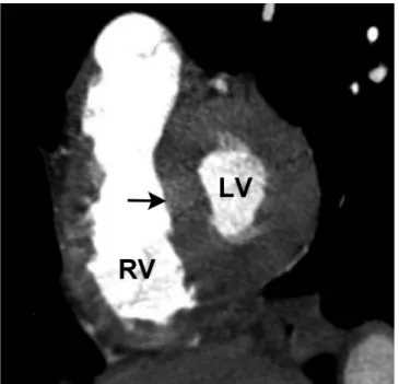 Table 2. Ventricular Functions in Chronic Obstructive Pulmonary  Disease Patients with Pulmonary Hypertension