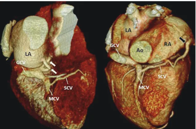Fig. 2. Volume-rendering images show two anomalous venous channels (white arrows) connecting coronary sinus and left atrium  (LA)
