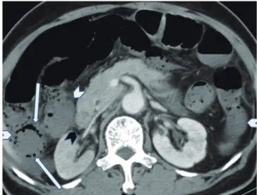 Table 1. Comparison of Ancillary CT Findings between SMAT and SMVT Groups