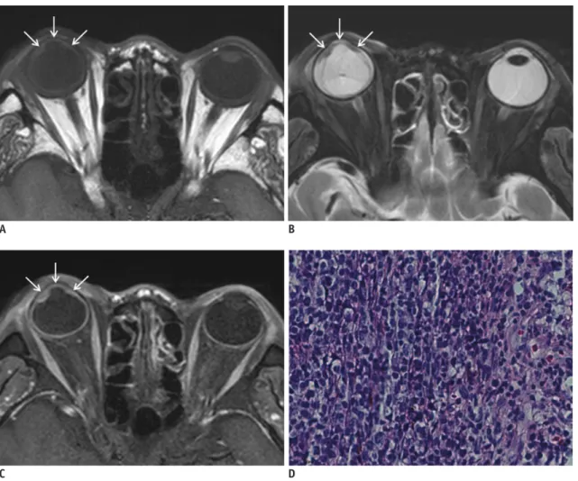 Fig. 1. Posttransplantation intraocular lymphoma.