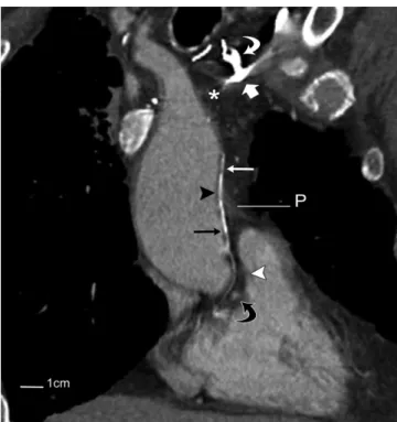 Figure 4 shows the single vessel in case 4; it coursed along  the left lateral wall of the ascending aorta and drained  into the right atrial appendage after passing under the  right coronary artery