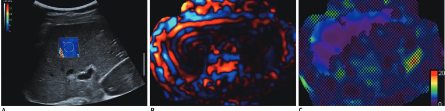 Fig. 2. Shear wave elastography (SWE) and magnetic resonance elastography (MRE) images in of 39-year-old liver donor