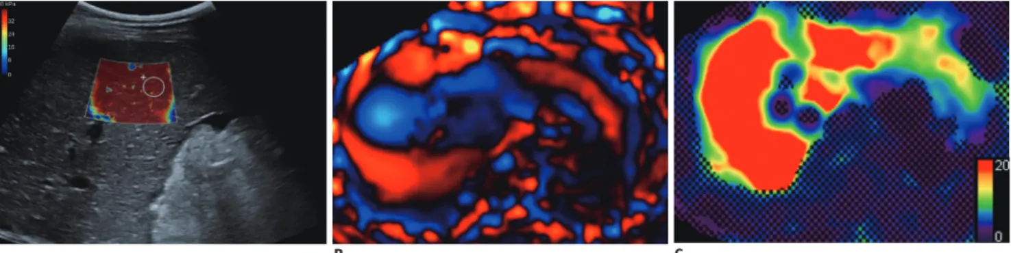 Fig. 3. Shear wave elastography (SWE) and magnetic resonance elastography (MRE) images in 40-year-old liver recipient due to  liver cirrhosis