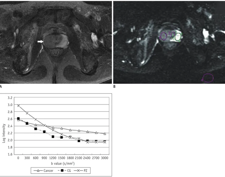 Fig. 1. Signal of  prostate cancer and normal tissue on DWI images at different b values and corresponding mono- and  biexponential parameter maps.