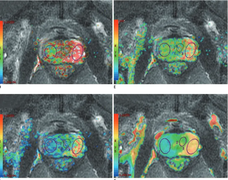 Fig. 1. Signal of  prostate cancer and normal tissue on DWI images at different b values and corresponding mono- and  biexponential parameter maps.