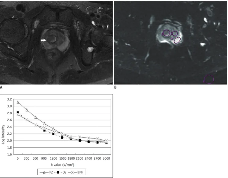 Fig. 2. Signal of prostate BPH and normal tissue on DWI images at different b values and corresponding mono- and biexponential  parameter maps.