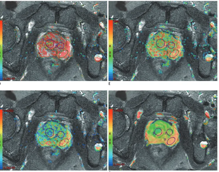 Fig. 2. Signal of prostate BPH and normal tissue on DWI images at different b values and corresponding mono- and biexponential  parameter maps.