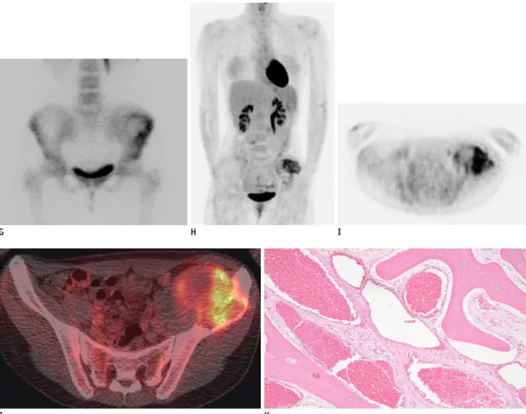 Fig. 1. Cavernous hemangioma of ileum in 22-year-old female mimicking aggressive malignant bone tumor with increased  activity on  18 F-FDG PET/CT.