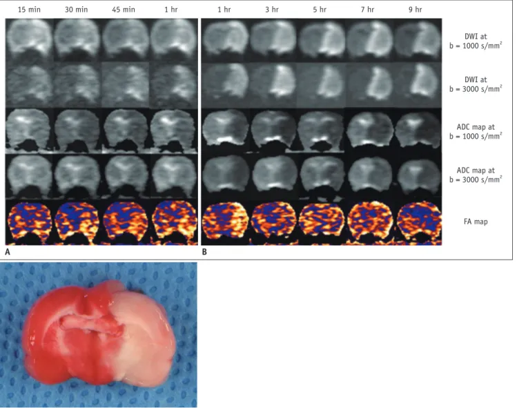 Fig. 1. Serial MRI patterns of hyperacute (A) and acute (B) ischemia on DWIs and ADC maps, at b = 1000 s/mm 2  and b = 3000 s/