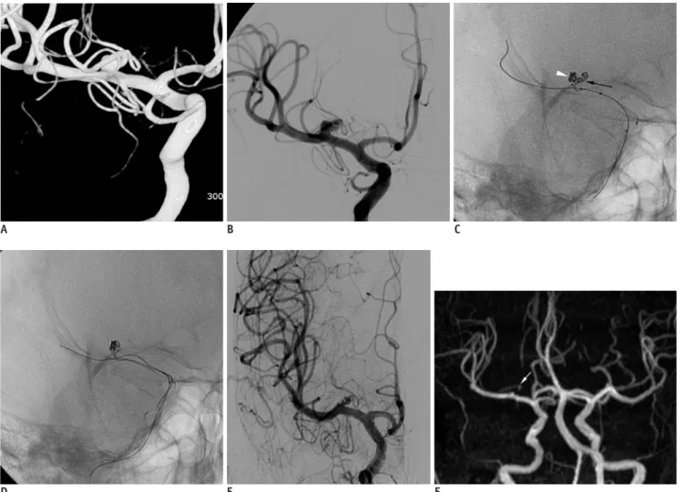 Fig. 1. Case 4. 55-year-old patient with unruptured aneurysm at right middle cerebral artery