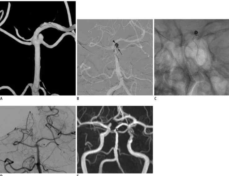 Fig. 3. Case 10. 53-year-old patient presenting with unruptured left distal internal carotid artery (ICA) aneurysm and left  superior cerebellar aneurysm