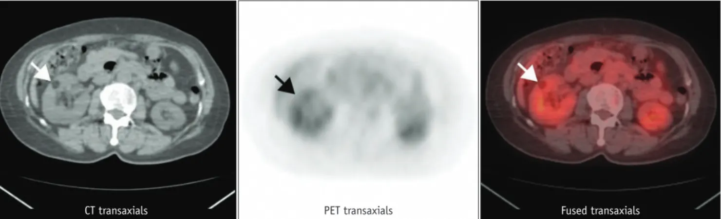Fig. 3. 30-year-old male with renal cell carcinoma in right kidney  (arrows). Maximum standardized uptake value on FDG PET is 5.43.