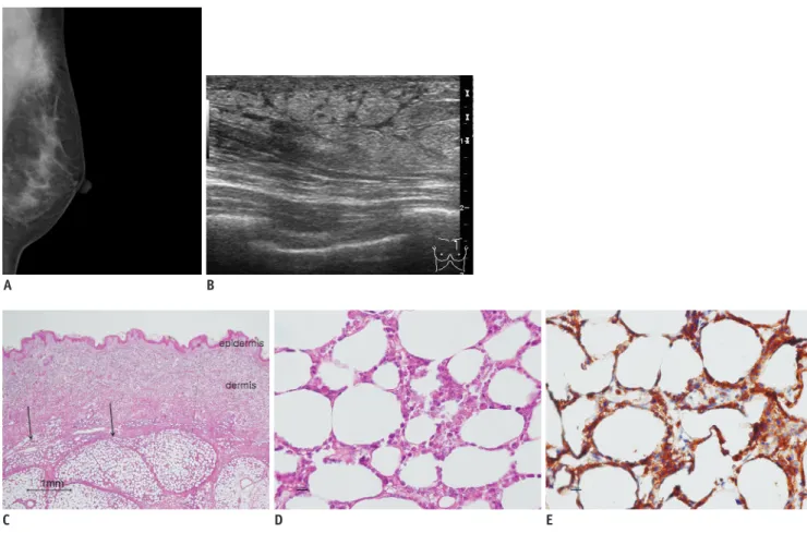 Fig. 1. Subcutaneous panniculitis-like T-cell lymphoma of breast in 43-year-old woman.