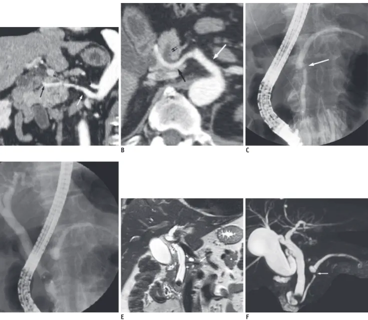 Fig. 1. Imaging findings of main pancreatic duct compression by intrapancreatic-replaced common hepatic artery in 63-year-old man.