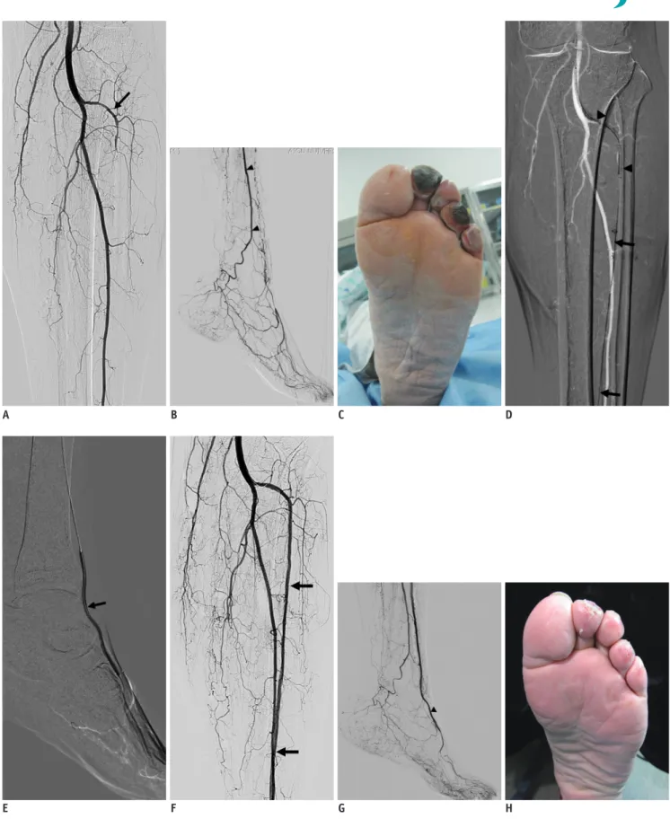 Fig. 1. Technical success was obtained in 60-year-old male with Rutherford category 5 critical limb ischemia.