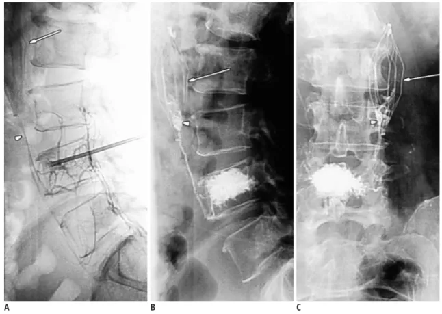 Fig. 1. Cement getting trapped in IVC filter during percutaneous vertebroplasty.