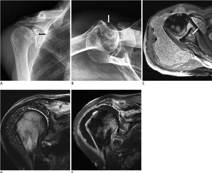 Fig. 1. Imaging and pathologic findings of  Candida septic arthritis in right shoulder in a 74-year-old man.