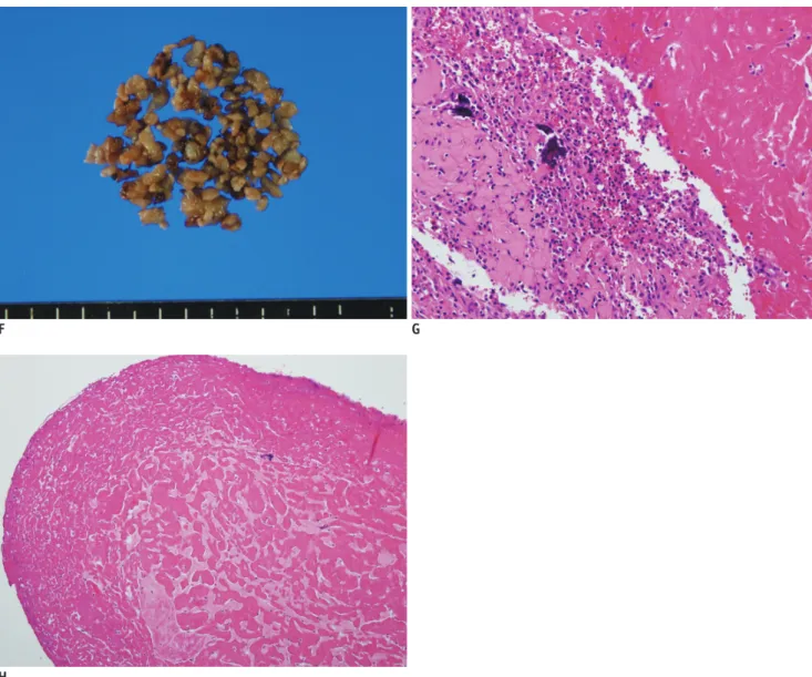Fig. 1. Imaging and pathologic findings of  Candida septic arthritis in right shoulder in a 74-year-old man.
