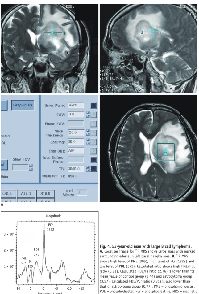 Fig. 4. 53-year-old man with large B cell lymphoma.