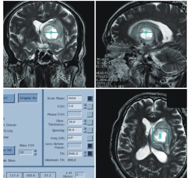 Fig. 5. 73-year-old man with brain abscess. 
