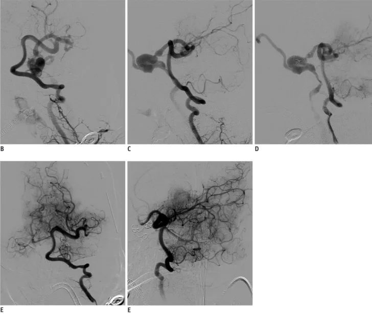 Fig. 1. The MRI/DSA presentation and embolism result of this pial AVF in a 4-month-old infant.