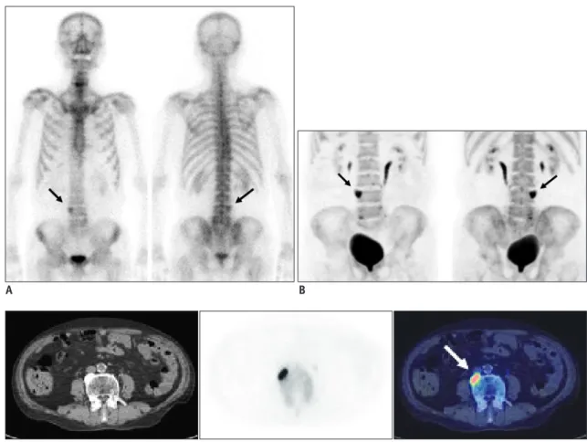 Fig. 2. Case demonstration showing higher specificity of bone positron emission tomography (PET) than bone scan in 77-year-old  male patient with colon cancer (no.14 in Table 1)