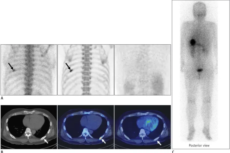 Fig. 4. Case demonstration showing false positivity of bone positron emission tomography (PET) and bone scan in 39-year-old  male patient with thyroid cancer (no.9 in Table 1).