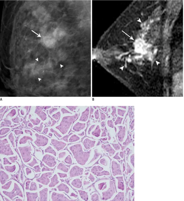 Fig. 1. Forty six-year-old woman with palpable mass in upper outer quadrant of right breast.