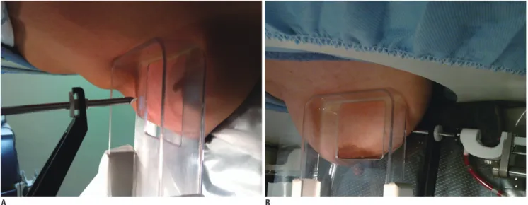 Fig. 1. Vertical and lateral approaches.