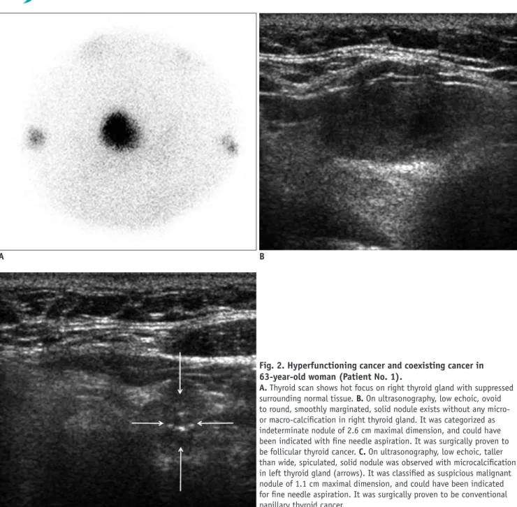 Fig. 2. Hyperfunctioning cancer and coexisting cancer in  63-year-old woman (Patient No
