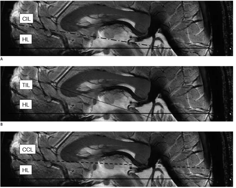 Fig. 5. Various intercommissural and extended cerebral reference lines in reference to horizontal line (HL : solid line).