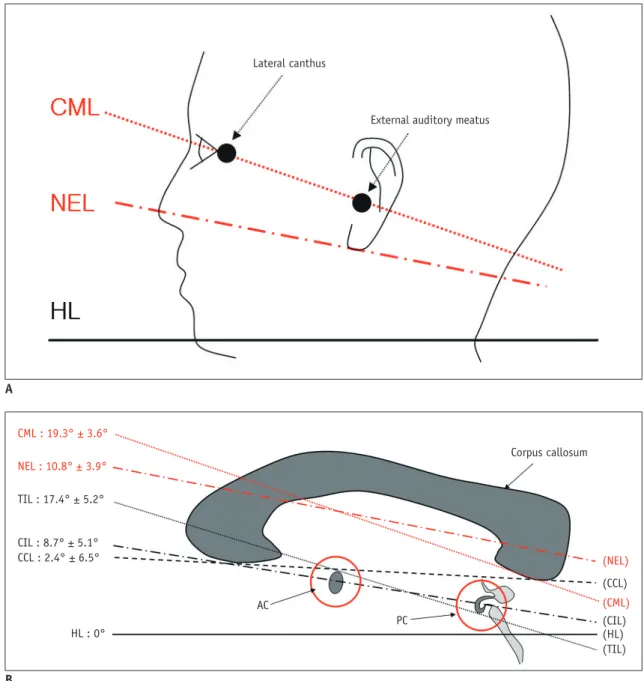 Fig. 6. Extracerebral &amp; intracerebral reference lines in reference to horizontal line.