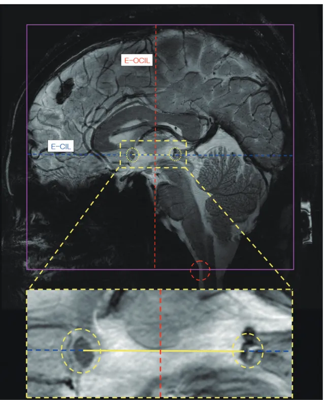 Fig. 7. Definition of virtual extension lines: Blue dotted line indicates extended central lintercommussural line