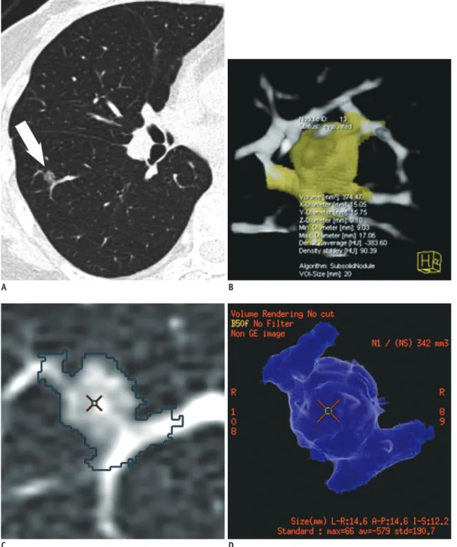 Fig. 3. 43-year-old woman with vessel-attached ground-glass nodule (GGN).