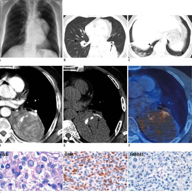 Fig. 1. Imaging and pathologic findings of 63-year-old man with malignant pulmonary PEComa (A-G) and modulation of PEC (H).