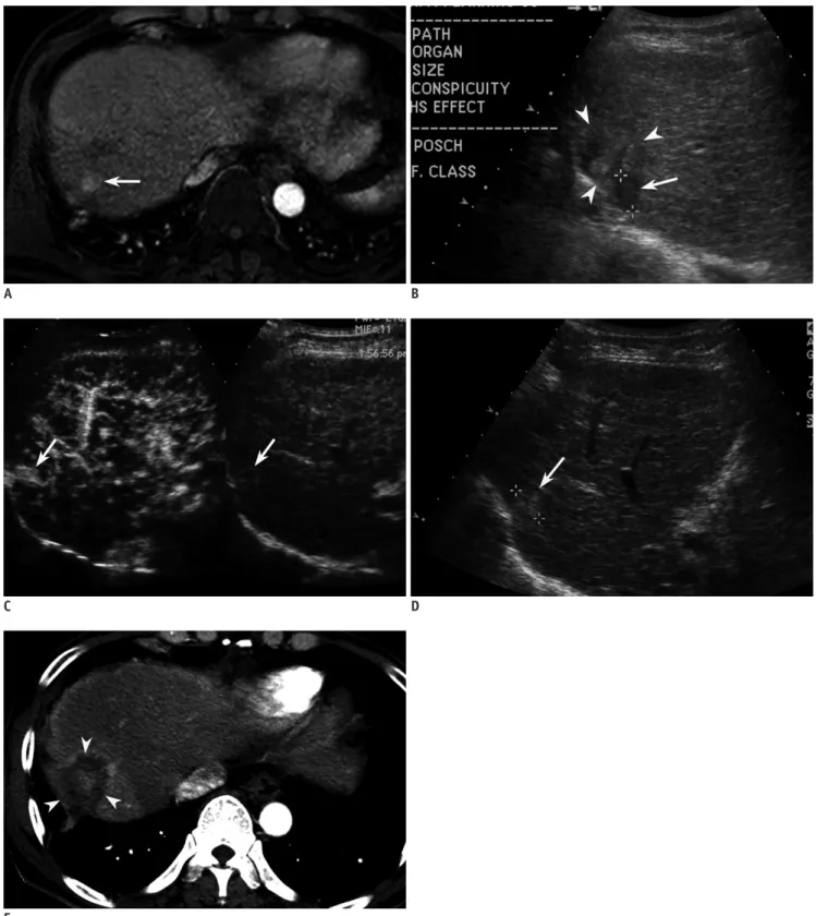 Fig. 2. Fifty eight-year-old man with 1.6-cm-sized hepatocellular carcinoma (HCC) in segment VII of liver