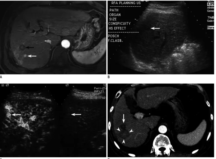 Fig. 3. Fifty nine-year-old man with 1 cm-sized hepatocellular carcinoma (HCC) in segment VII of liver.