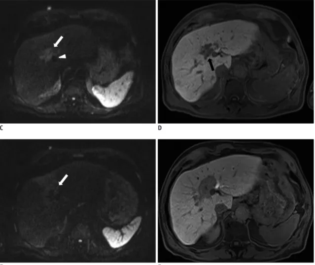 Fig. 1. Pre-interventional angiography and intra-procedural CT scan and pre-and post-ablation MR images.