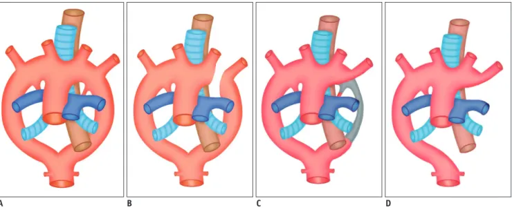 Fig. 3. Schematic figure of vascular ring.